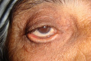 Patient with ectropion with tearing and chronic eye pain--before surgery
