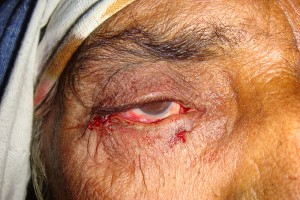 After surgery: nnote eyelid is in a tighter, higher position and this patient will now be free of pain and tearing