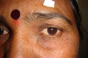 Patient with chronically infected tear sac causing discomfort and recurrent eye infections