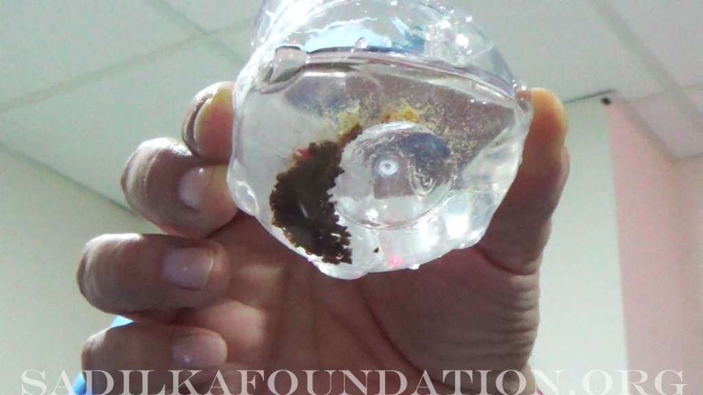 Extracted kidney stones