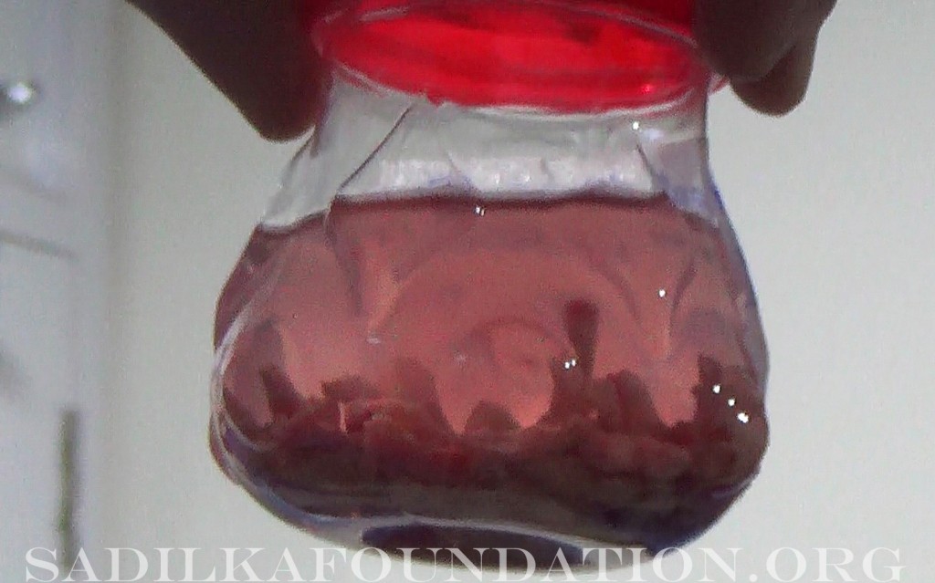 Extracted prostate gland fragments. 