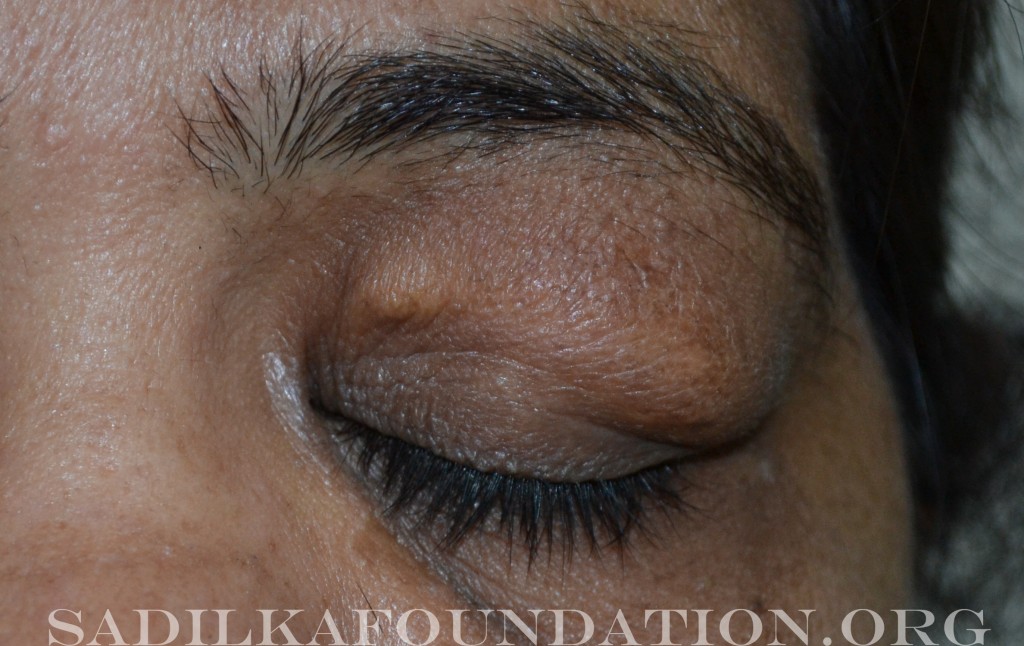 Patient with tumors of the eyelid causing recurrent bouts of severe swelling and visual impairment.