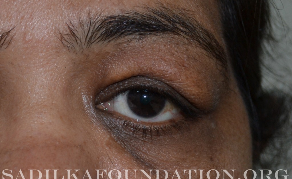 Eyelid tumors