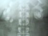 calyceal-tic-and-staghorn