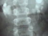 horseshoe-kidneys-with-staghorns