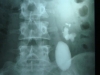pelvic-kidney-with-large-stones