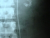 staghorn2